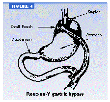 Roux-en-Y Gastric Bypass